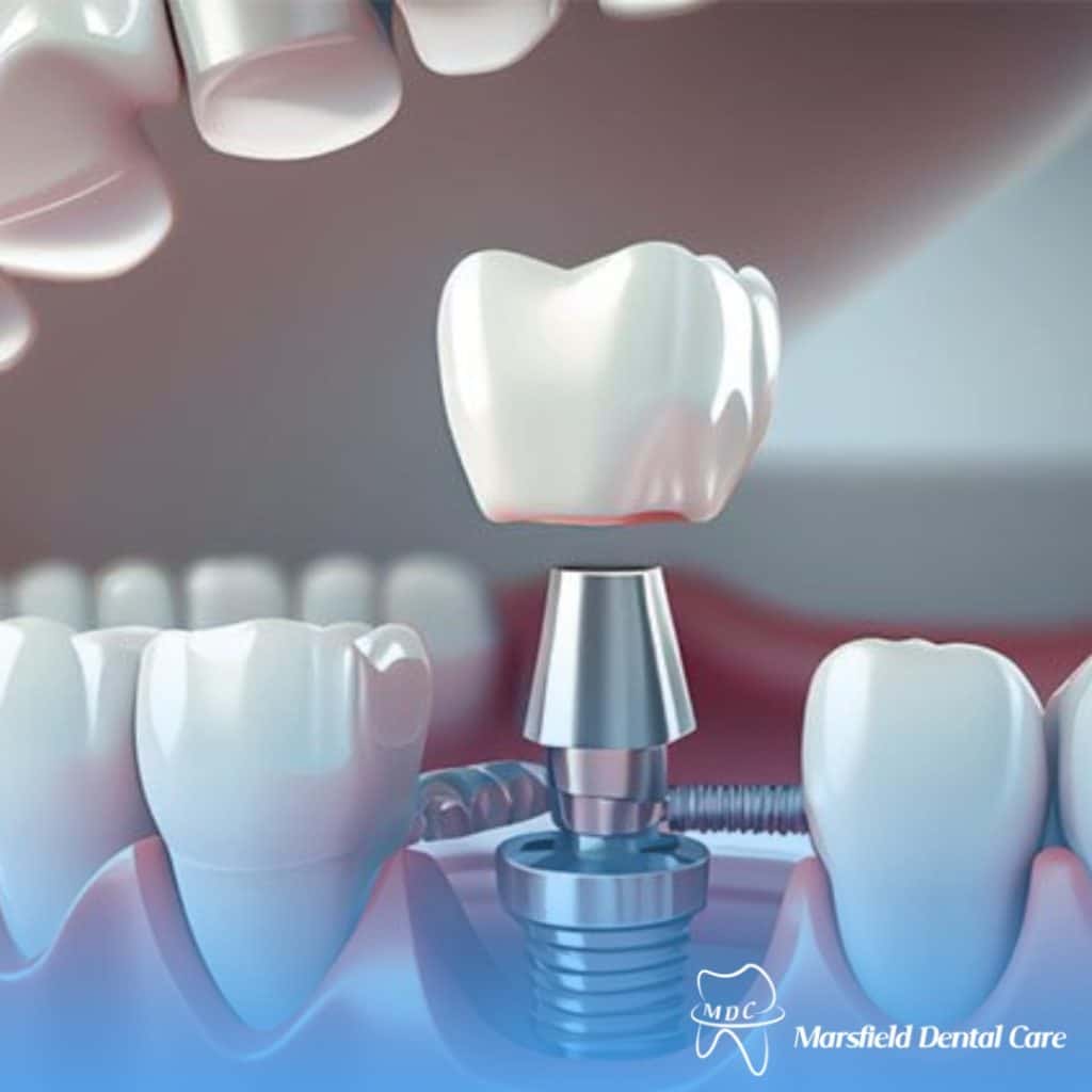 Experienced dentist showing a dental implant model to a patient in a modern dental clinic, explaining the benefits of dental implants for tooth replacement.