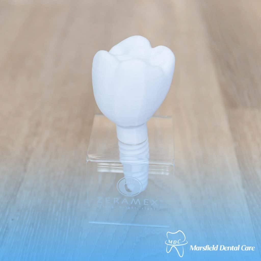 image presents a metal free dental implant on clear display unit