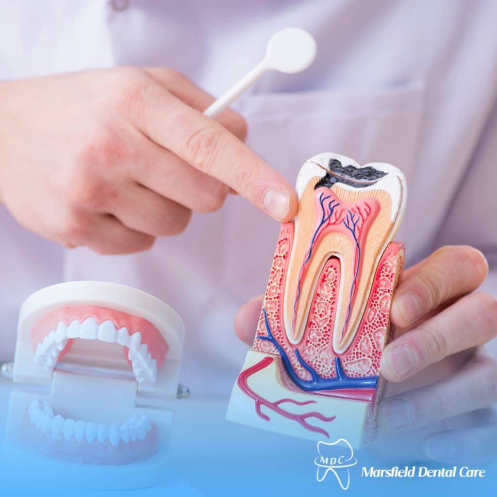 Dentist holding and explaining a dental root anatomy model to illustrate a root canal procedure.