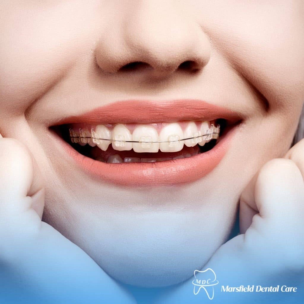 Teenage girl with a big smile, showing off her braces for effective teeth straightening.