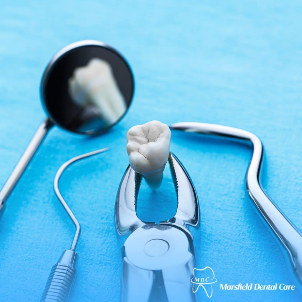 Close-up of dental extraction forceps holding a tooth, laid on a blue sterile drape surrounded by various dental tools, illustrating a tooth extraction procedure.