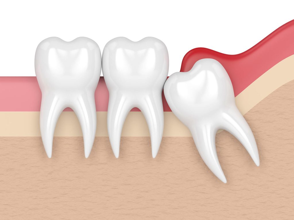 Concept of different types of wisdom teeth problems.|Concept of different types of wisdom teeth problems.