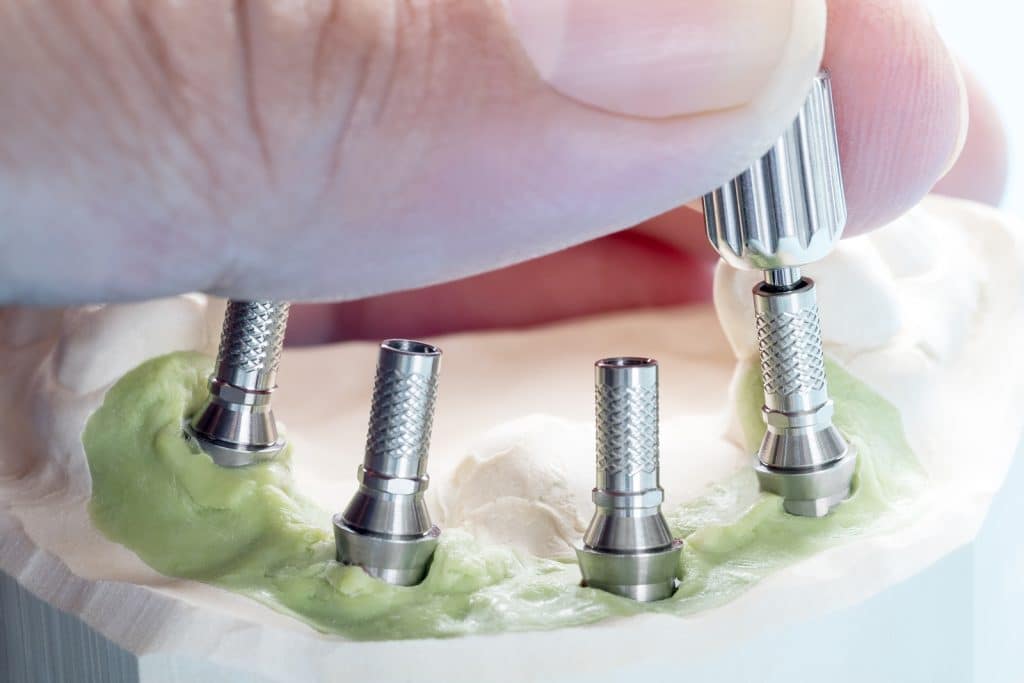 close up image of All-on-4 Dental Implants