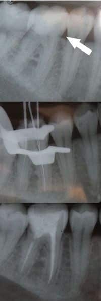 Root canal therapy