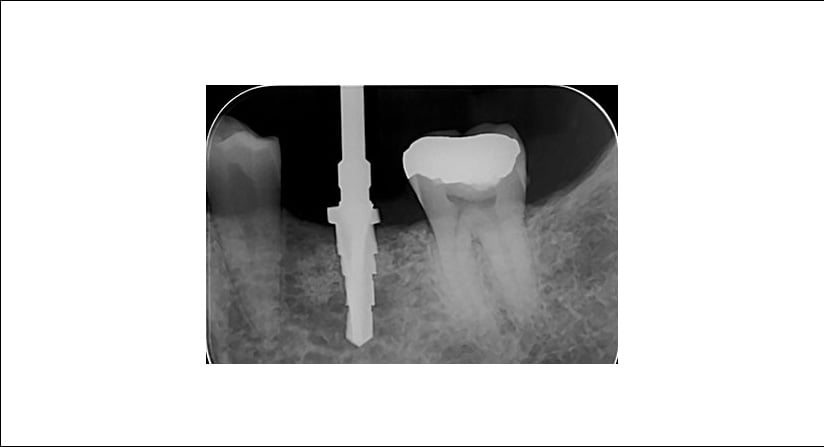 5-implant-drill