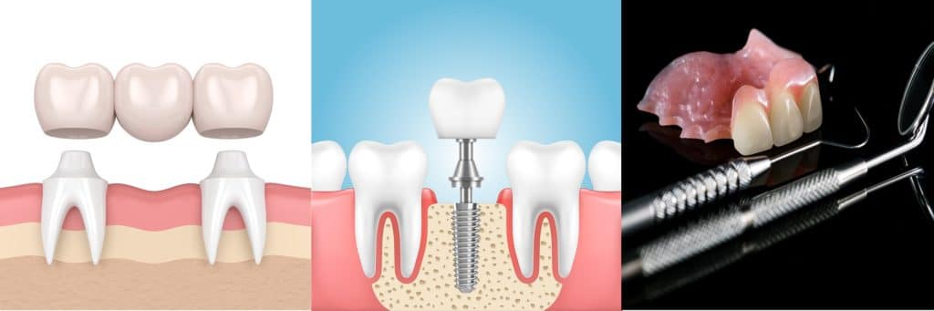 Three grid images showcasing dental implants
