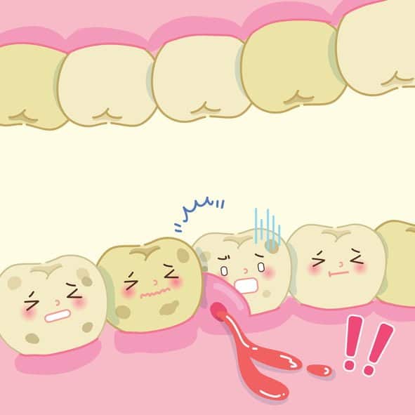 Gum-Disease