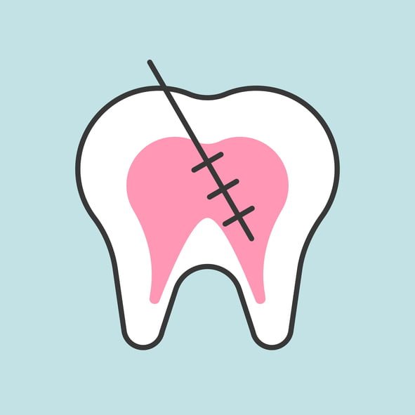 root canal