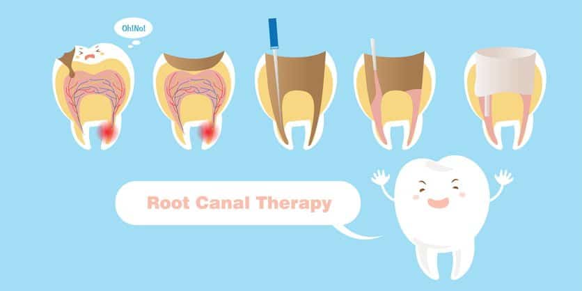 Root canal therapy by Marsfield Dental Care