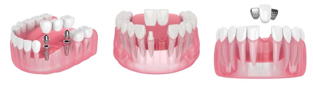 Grid image showcasing types of dental bridges