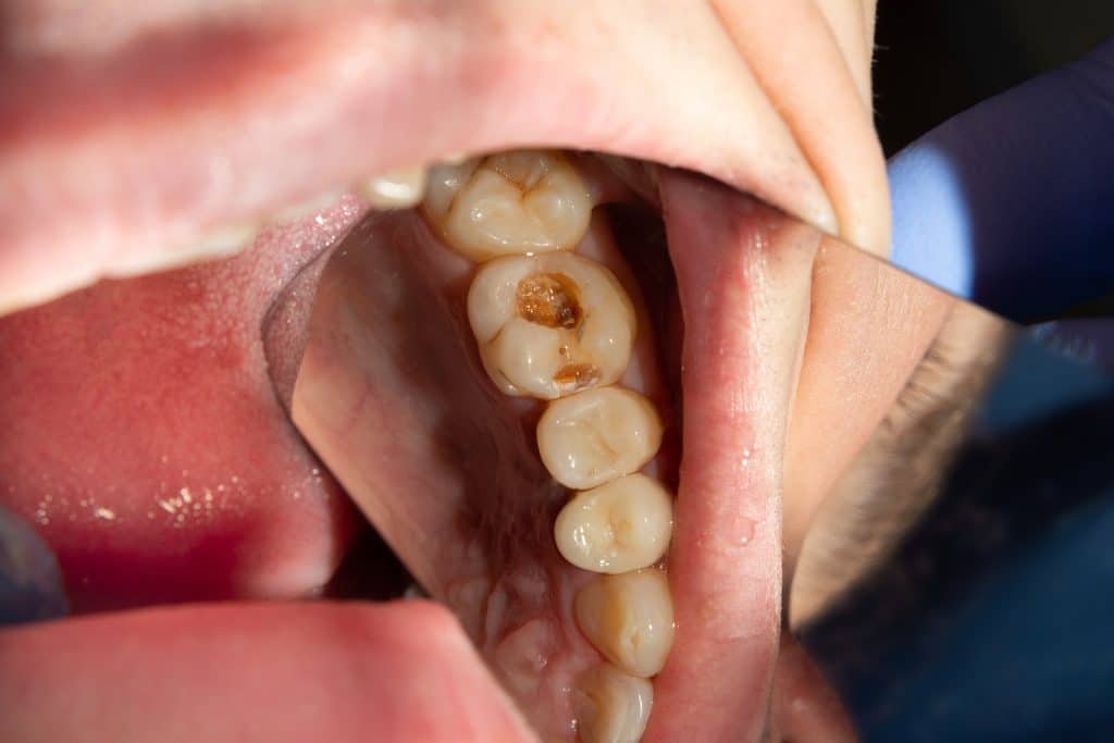 Close up image of tooth decay treatment by Marshfield Dental Care
