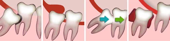 Wisdom Teeth Complications