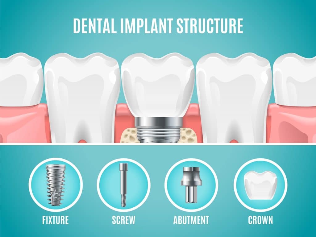 Dental implant structure.