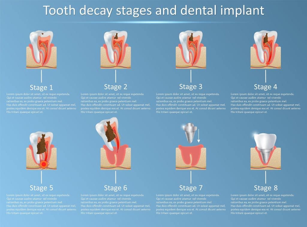 Tooth decay stages and dental implant vector illustration