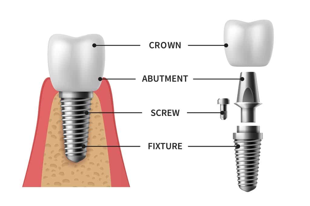 screw denture orthodontic implantation teeth