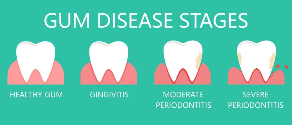 The stages of gum disease