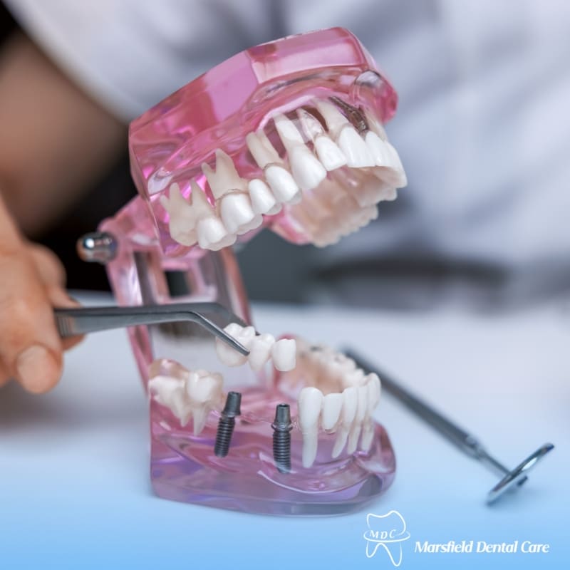 Image presents Dental Bridge Canterbury