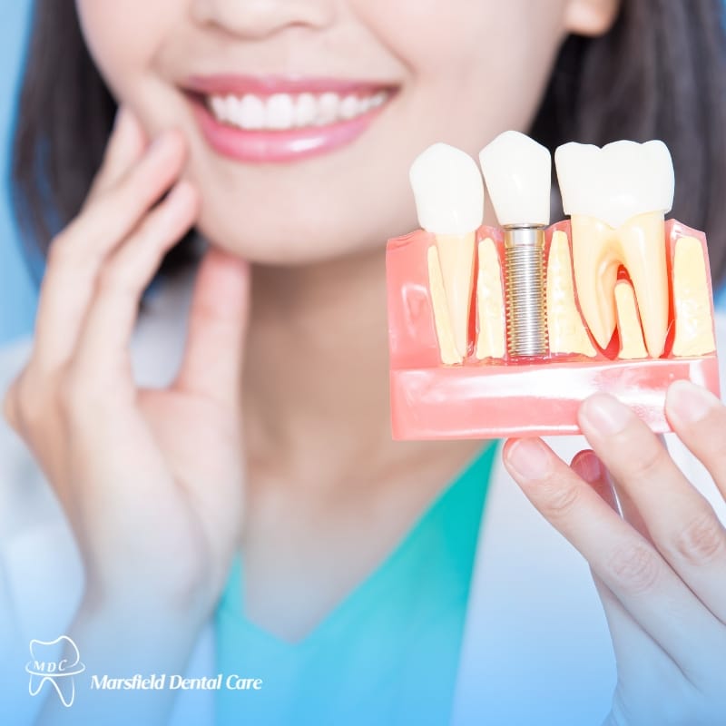 image presents Dental Implant Lakemba