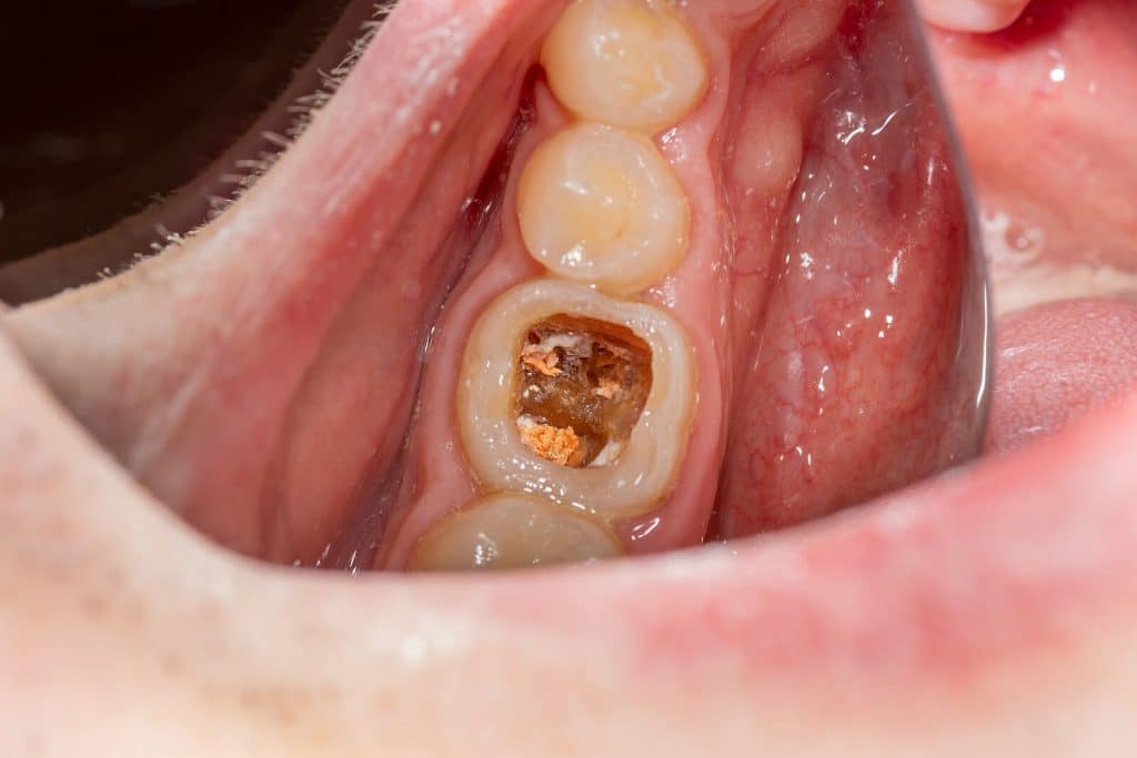 Close up image of gold dental filling by Marshfield Dental Care|Close up image of gold dental filling