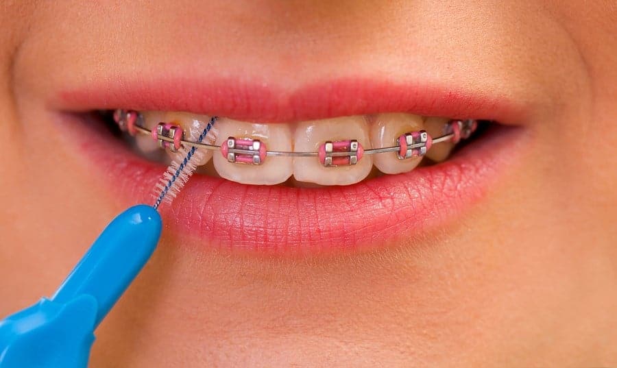 Properly Cleaning Braces||
