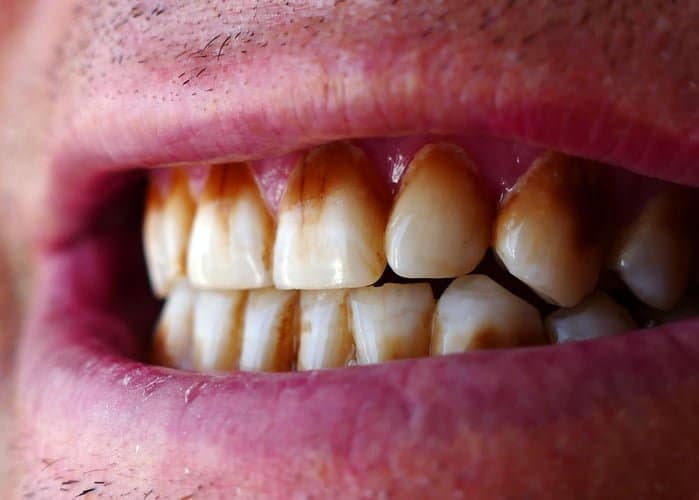 stained-teeth