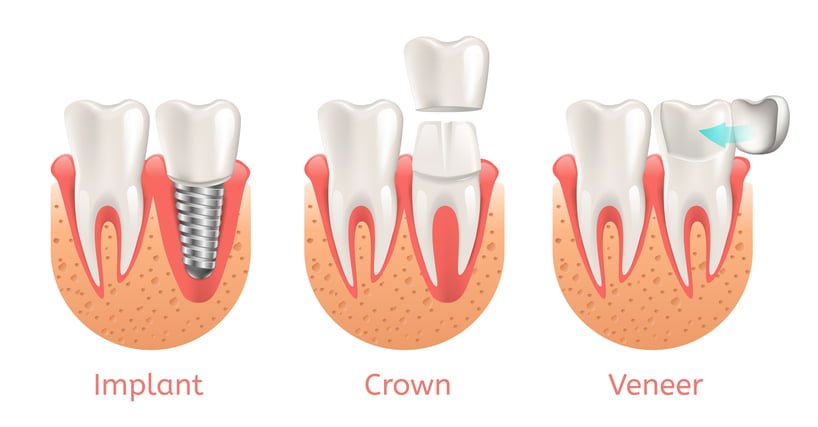 veneer-implant-crown