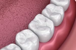 Close-up of a row of teeth with a tooth coloured filling