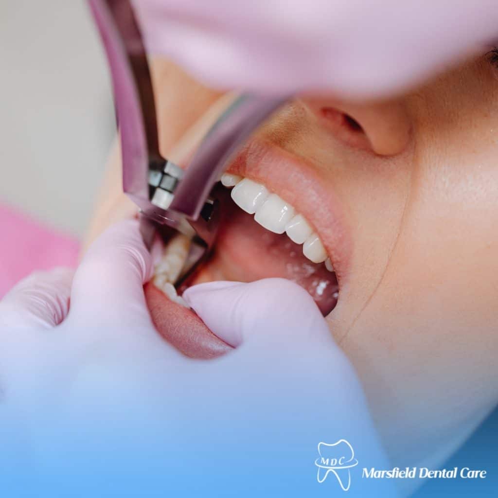 Tooth restoration procedure at Marsfield Dental Care—dentist extracting damaged tooth with forceps for same-day restoration in Sydney.