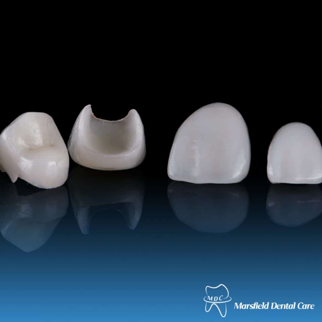 Porcelain veneers in different shapes and sizes, showcasing high-quality dental restorations for cosmetic smile enhancement at Marsfield Dental Care.