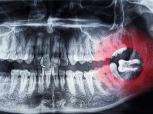 xray picture of a wisdom teeth causing pain after ignoring wisdom tooth removal aftercare.