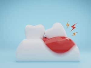 Cartoon tooth with inflamed gum, highlighting delay tooth crown risks like pain and infection.