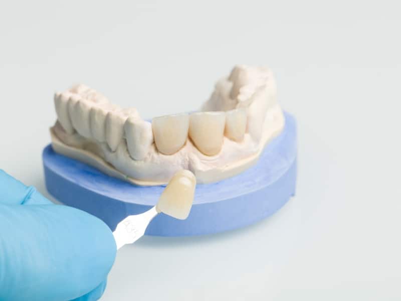 Dental technician matching a crown to a plaster model. Delay tooth crown risks include further decay and structural damage