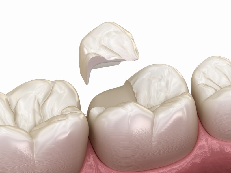 A dental illustration showing a cracked dental crown partially detached from a molar tooth, revealing the underlying tooth structure. The crack is visible on the surface of the crown.
