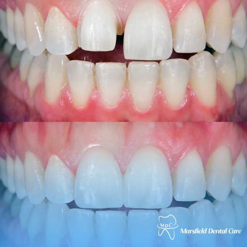 Composite Bonding before and after image showing improved tooth shape, alignment, and colour.