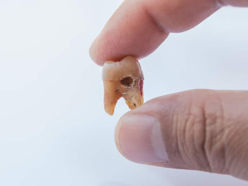 A decayed molar with a visible cavity, held between two fingers, suggestive of a diy tooth extraction.