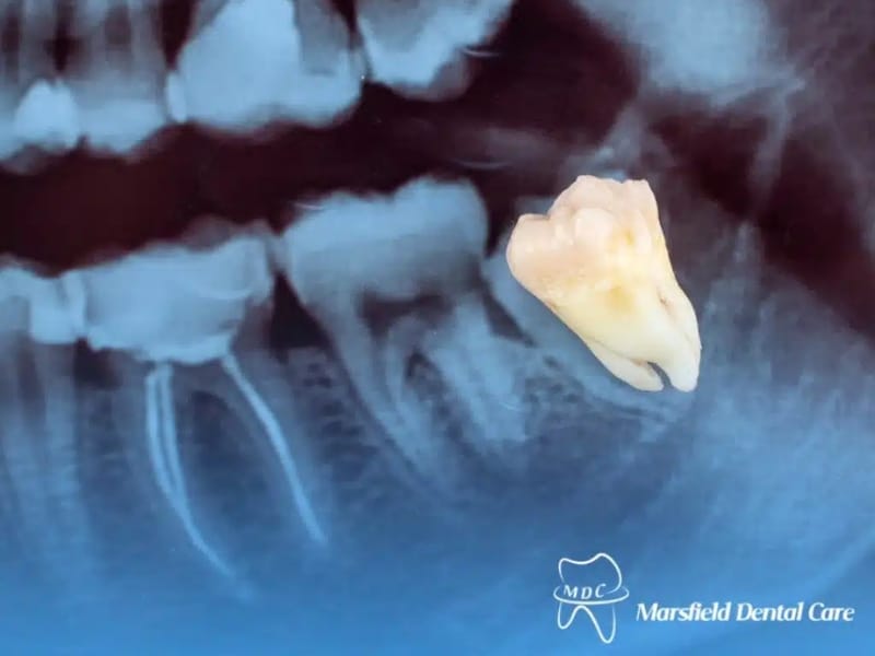 Wisdom tooth extraction X-ray showing impacted molar with removed tooth overlay