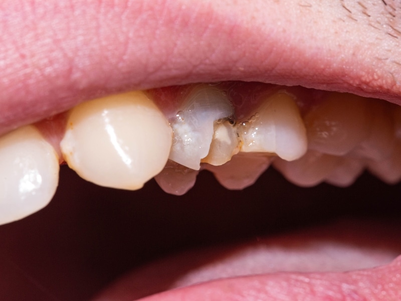 Tooth Restoration for severe dental decay on molar tooth