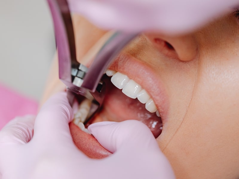 Close-up of dental procedure using forceps for tooth restoration on lower molar with patient’s mouth open.