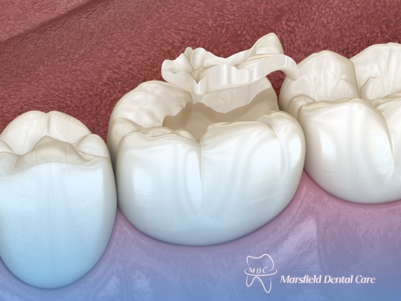 Tooth Sealant applied to molar surface to protect against cavities and decay in children's back teeth.